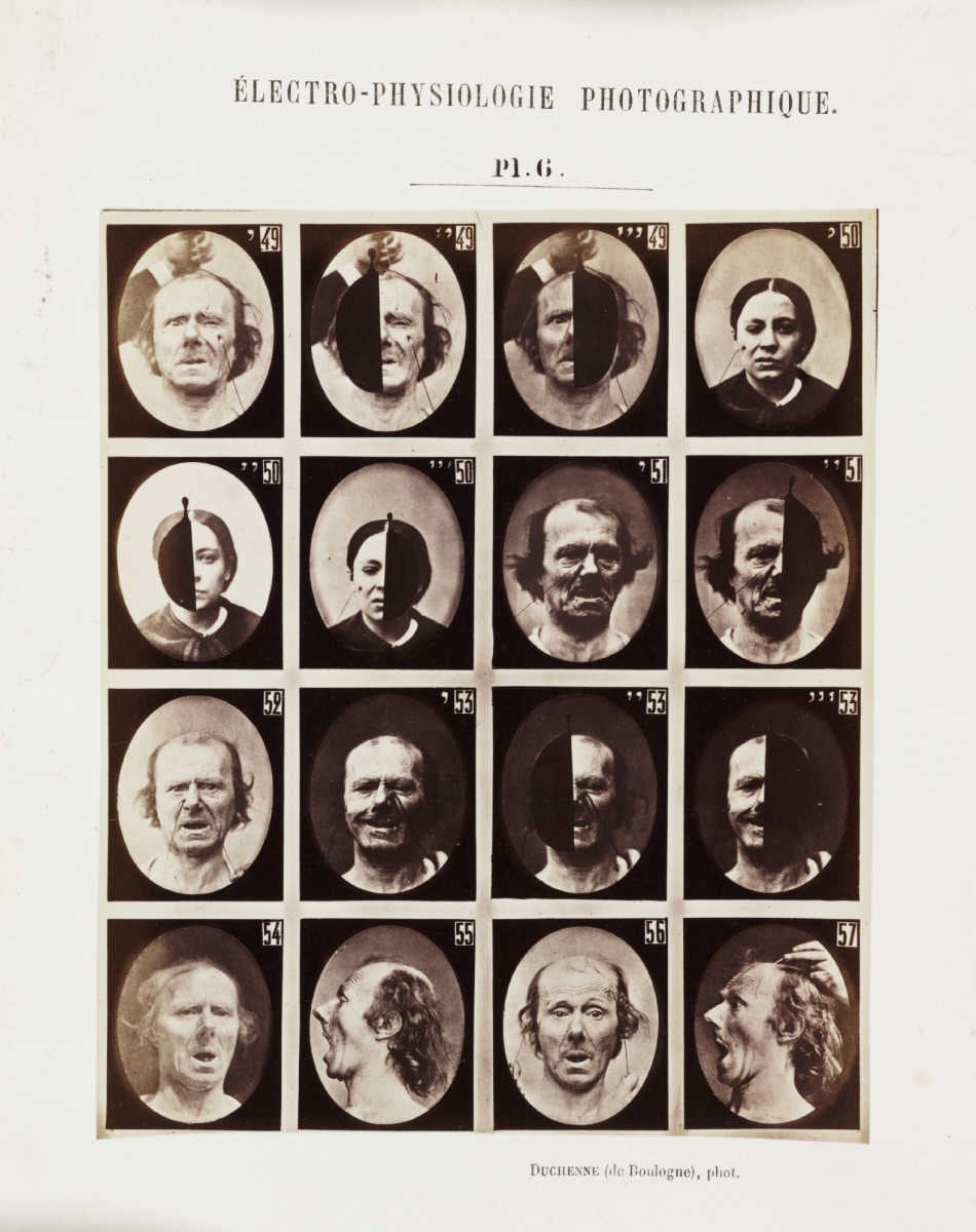 Figure 2 — Duchenne (right) applying surface electrodes to the face of a subject during his electrophysiological studies of expression, early 1860s. The moistened pad electrode on the skin — not a needle bene…