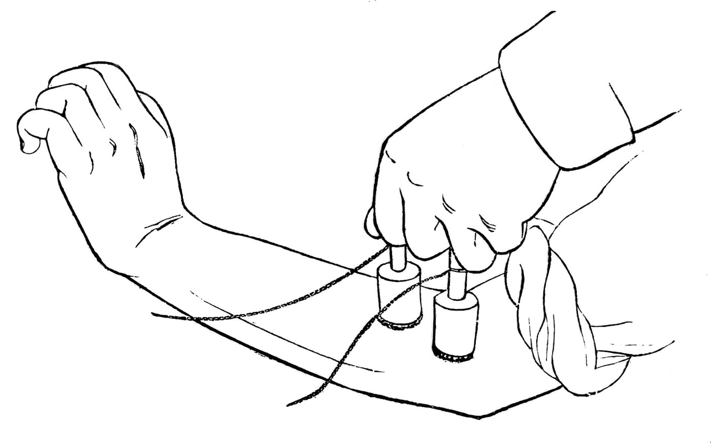 Figure 2 — The business end of a medical battery: two insulated handles terminating in metal electrodes wrapped in moistened sponge, used to apply the current to a mapped point on the skin.